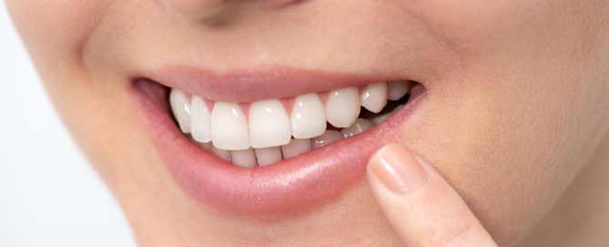 Teeth Whitening (2)